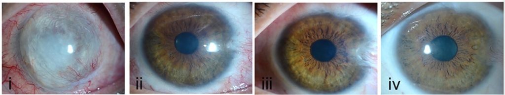 الخلايا الجذعية تقنية واعدة لعلاج الإصابات البالغة في العين